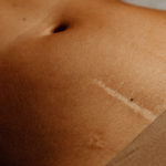 endometrioza